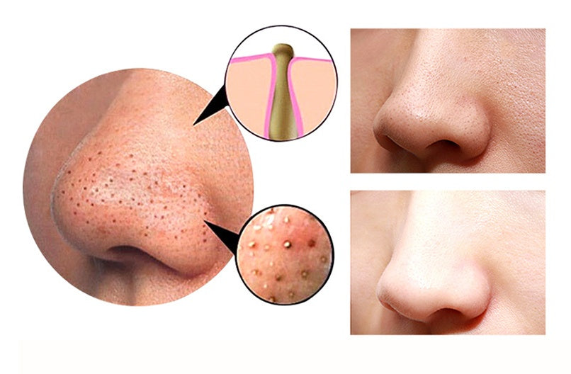Before and after comparison of nose skin with blackheads and clean pores, with close-up diagrams showing blackhead formation and skin improvement