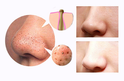 Before and after comparison of nose skin with blackheads and clean pores, with close-up diagrams showing blackhead formation and skin improvement